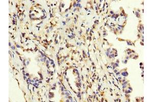 IHC image of ABIN7159260 diluted at 1:200 and staining in paraffin-embedded human lung cancer performed on a Leica BondTM system. (MAGEA3 Antikörper  (AA 2-104))