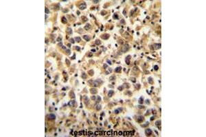 CCDC19 Antibody (N-term) immunohistochemistry analysis in formalin fixed and paraffin embedded human testis carcinoma followed by peroxidase conjugation of the secondary antibody and DAB staining. (CCDC19 Antikörper  (N-Term))