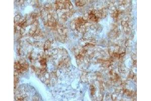 Formalin-fixed, paraffin-embedded human renal cell carcinoma stained with Cadherin 16 antibody (CDH16/1071) (Cadherin-16 Antikörper)