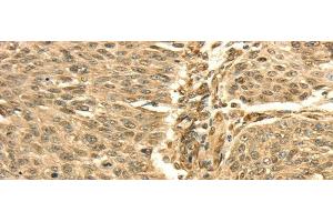 Immunohistochemistry of paraffin-embedded Human lung cancer using SEPT2 Polyclonal Antibody at dilution of 1/30 (Septin 2 Antikörper)