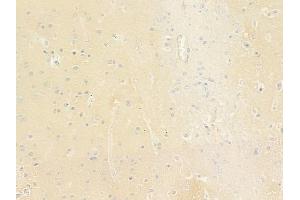 ABIN6264831 and ABIN6279042 at 1/100 staining human glioblastoma by IHC-P. (RPL24 Antikörper  (Internal Region))