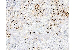 IHC analysis of CEACAM5 using anti-CEACAM5 antibody (ABIN7601435).