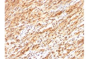 Formalin-fixed, paraffin-embedded human Schwanoma stained with S100B Rabbit Polyclonal Antibody. (S100B Antikörper)