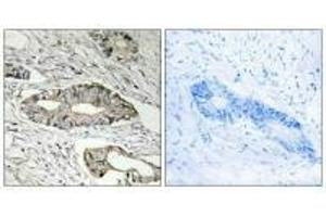 Immunohistochemistry analysis of paraffin-embedded human colon carcinoma tissue, using EPN3 antibody. (EPN3 Antikörper)