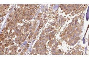 ABIN6278939 at 1/100 staining Human Melanoma tissue by IHC-P. (CYB5R4 Antikörper  (N-Term))