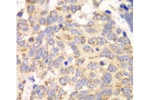 Immunohistochemistry of paraffin-embedded Human esophageal cancer using HAGH Polyclonal Antibody at dilution of 1:100 (40x lens). (HAGH Antikörper)