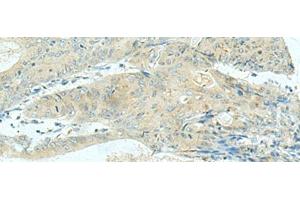 Immunohistochemistry of paraffin-embedded Human colorectal cancer tissue using KIF21B Polyclonal Antibody at dilution of 1:40(x200)