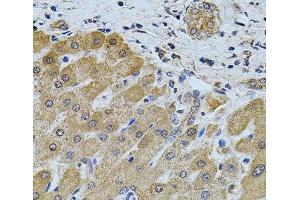 Immunohistochemistry of paraffin-embedded Human liver damage using FoxO3a Polyclonal Antibody at dilution of 1:100 (40x lens). (FOXO3 Antikörper)