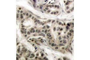 Immunohistochemistry of paraffin-embedded human breast carcinoma using Phospho-NFKB1-S337 antibody (ABIN2987371). (NFKB1 Antikörper  (pSer337))