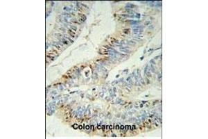 PHL Antibody (C-term) (ABIN652395 and ABIN2841923) IHC analysis in formalin fixed and paraffin embedded colon carcinoma followed by peroxidase conjugation of the secondary antibody and DAB staining. (PHLPP2 Antikörper  (C-Term))