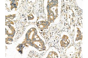 ABIN6261168 and ABIN6276665 at 1/100 staining Human colorectal cancer by IHC-P.