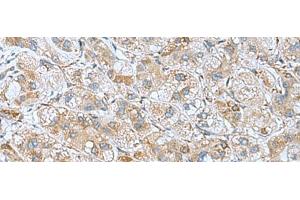 Immunohistochemistry of paraffin-embedded Human liver cancer tissue using DHX58 Polyclonal Antibody at dilution of 1:60(x200) (DHX58 Antikörper)