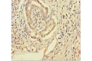 Immunohistochemistry of paraffin-embedded human pancreatic cancer using ABIN7170557 at dilution of 1:100 (SMPD3 Antikörper  (AA 401-655))