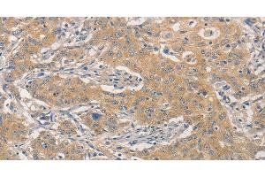 Immunohistochemistry of paraffin-embedded Human gastric cancer using NFE2L1 Polyclonal Antibody at dilution of 1:30 (NFE2L1 Antikörper)