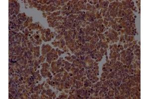 IHC image of ABIN7127384 diluted at 1:100 and staining in paraffin-embedded human lung cancer performed on a Leica BondTM system. (Rekombinanter Caspase 2 Antikörper)