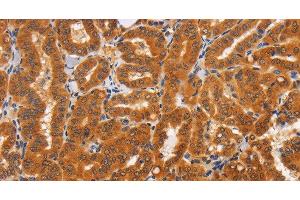 Immunohistochemistry of paraffin-embedded Human thyroid cancer tissue using TNFRSF8 Polyclonal Antibody at dilution 1:60 (TNFRSF8 Antikörper)