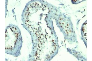 Formalin-fixed, paraffin-embedded human Testicular Carcinoma stained with Nucleolin Monoclonal Antibody (364-5 + NCL/902). (Nucleolin Antikörper)