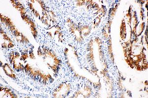 Anti-COX2/Cyclooxygenase 2 antibody, IHC(P) IHC(P): Human Intestinal Cancer Tissue