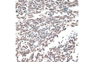Immunohistochemistry of paraffin-embedded human lung cancer using AQR antibody (ABIN6133411, ABIN6137057, ABIN6137058 and ABIN6221662) at dilution of 1:100 (40x lens). (AQR Antikörper  (AA 400-700))