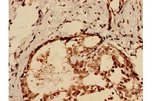 Immunohistochemistry analysis of human breast cancer using ABIN7147553 at dilution of 1:100 (CHID1 Antikörper  (AA 20-393))