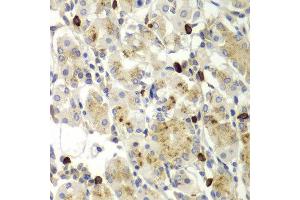 Immunohistochemistry of paraffin-embedded human gastric using MMP9 antibody at dilution of 1:100 (x400 lens). (MMP 9 Antikörper)