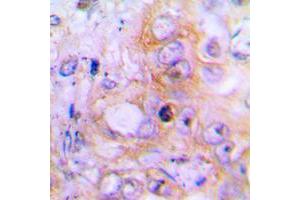 Immunohistochemical analysis of BMP2 staining in human lung cancer formalin fixed paraffin embedded tissue section. (BMP2 Antikörper  (Center))