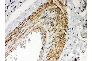 IHC-P: PKC iota antibody testing of human lung cancer tissue (PKC iota Antikörper  (AA 21-214))