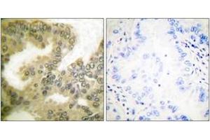 Immunohistochemistry analysis of paraffin-embedded human lung carcinoma, using Cyclin D3 (Phospho-Thr283) Antibody. (Cyclin D3 Antikörper  (pSer283))