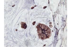 Immunohistochemical staining of paraffin-embedded Adenocarcinoma of Human colon tissue using anti-PFKP mouse monoclonal antibody. (PFKP Antikörper)