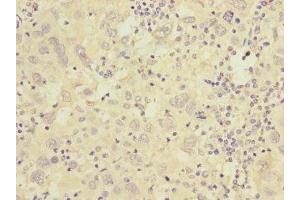 Immunohistochemistry of paraffin-embedded human liver cancer using ABIN7175576 at dilution of 1:100 (CACNG7 Antikörper  (AA 156-275))