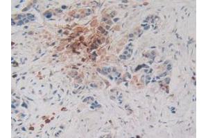 IHC-P analysis of Human Breast Cancer Tissue, with DAB staining. (CPB2 Antikörper  (AA 138-423))