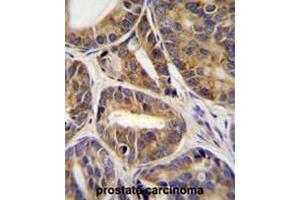 RNF215 Antibody (C-term) immunohistochemistry analysis in formalin fixed and paraffin embedded human prostate carcinoma tissue followed by peroxidase conjugation of the secondary antibody and DAB staining.