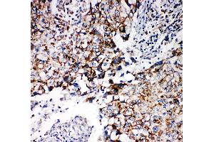 Anti-REA antibody, IHC(P) IHC(P): Human Lung Cancer Tissue (Prohibitin 2 Antikörper  (Middle Region))