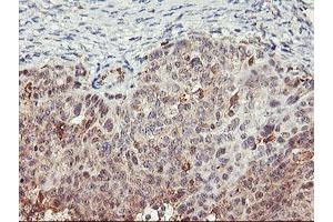 Immunohistochemical staining of paraffin-embedded Adenocarcinoma of Human ovary tissue using anti-TULP3 mouse monoclonal antibody. (TULP3 Antikörper)