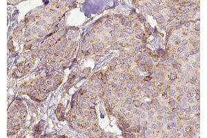 ABIN6272975 at 1/100 staining Human breast cancer tissue by IHC-P.