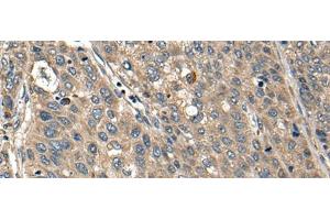 Immunohistochemistry of paraffin-embedded Human liver cancer tissue using FCGR1A Polyclonal Antibody at dilution of 1:35(x200) (FCGR1A Antikörper)
