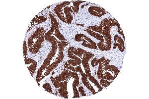 Colorectal adenocarcinoma with intense membranous cytoplasmic and nuclear beta catenin positivity of all tumor cells