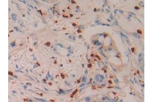 Detection of AZU in Human Bile duct cancer Tissue using Polyclonal Antibody to Azurocidin (AZU)