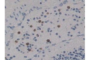 Detection of Ntn4 in Human Lung Cancer Tissue using Polyclonal Antibody to Netrin 4 (Ntn4) (Netrin 4 Antikörper  (AA 349-592))