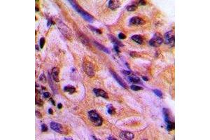 Immunohistochemical analysis of CDC42EP4 staining in human lung cancer formalin fixed paraffin embedded tissue section. (CDC42EP4 Antikörper)