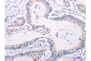 The image on the left is immunohistochemistry of paraffin-embedded Human colon cancer tissue using ABIN7189656(ADAMTS17 Antibody) at dilution 1/60, on the right is treated with synthetic peptide. (ADAMTS17 Antikörper)