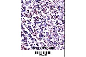 CAPN11 Antibody immunohistochemistry analysis in formalin fixed and paraffin embedded human testis carcinoma followed by peroxidase conjugation of the secondary antibody and DAB staining. (CAPN11 Antikörper  (AA 409-438))