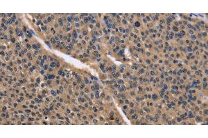 Immunohistochemistry of paraffin-embedded Human liver cancer using IDH1 Polyclonal Antibody at dilution of 1:50 (IDH1 Antikörper)