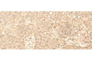 Immunohistochemistry of paraffin-embedded Human ovarian cancer tissue using FAH Polyclonal Antibody at dilution of 1:40(x200) (FAH Antikörper)