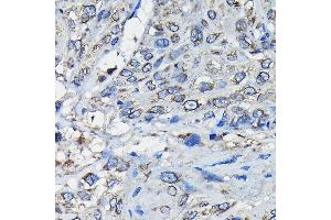 Immunohistochemistry of paraffin-embedded human esophageal cancer using RanG Rabbit pAb (ABIN6128613, ABIN6146681, ABIN6146683 and ABIN6217306) at dilution of 1:50 (40x lens). (RANGAP1 Antikörper  (AA 398-587))