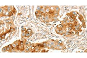 Immunohistochemistry of paraffin-embedded Human breast cancer using ACE1 Polyclonal Antibody at dilution of 1:70 (Angiotensin I Converting Enzyme 1 Antikörper)