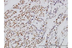 Immunoperoxidase of monoclonal antibody to SYMPK on formalin-fixed paraffin-embedded human ovary, clear cell carcinoma. (Symplekin Antikörper  (AA 1-533))