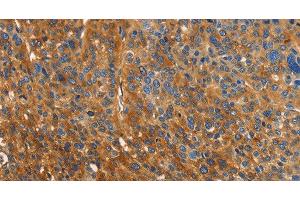 Immunohistochemistry of paraffin-embedded Human liver cancer using ORM2 Polyclonal Antibody at dilution of 1:40