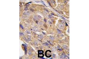 Formalin-fixed and paraffin-embedded human breast carcinoma tissue reacted with EIF4B-, which was peroxidase-conjugated to the secondary antibody, followed by DAB staining. (EIF4B Antikörper  (AA 400-429))
