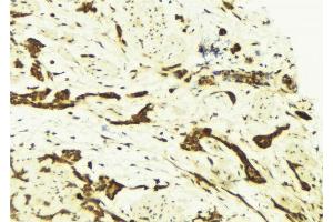 ABIN6269249 at 1/100 staining Human breast cancer tissue by IHC-P.